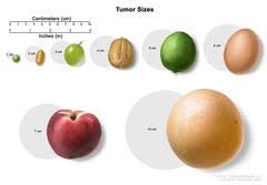 Tumor Size Centimeters Image Details Nci Visuals Online