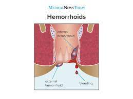 Maybe you would like to learn more about one of these? Hemorrhoids During Pregnancy Symptoms Treatment And More