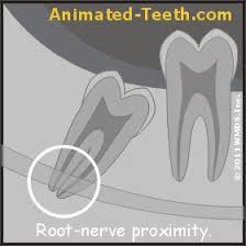 after wisdom tooth removal or injection