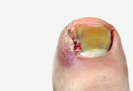 ingrown toenail doctor ingrown