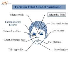 Frequent anomalies are laryngeal malformation (or cleft) and a high carina or tracheoesophageal fistula. Fetal Alcohol Spectrum Disorders Ira J Chasnoff Md