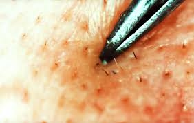 ingrown hair removal how to get rid of