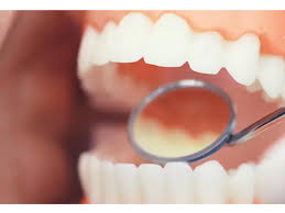 tooth cavity