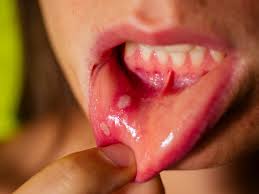 mouth ulcer is cancerous