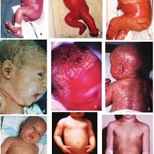 It is the most severe type of ichthyosis. The Childhood Spectrum Of Non Bullous Non Syndromic Ichthyosis A A Download Scientific Diagram