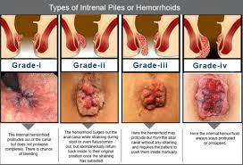 For severe or persistent hemorrhoids, the best thing to do is to see your doctor for treatment; Hemorrhoids Flashcards Quizlet