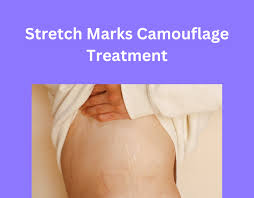 stretch marks camouflage treatment