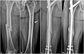 atypical fem fracture