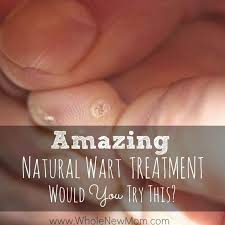natural remes for warts plus a truly