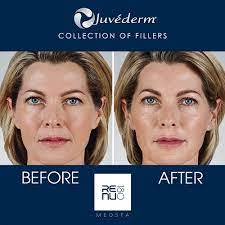 how long does juvederm take to set in