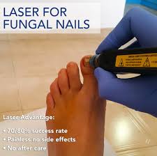 laser for fungal nails foot podiatrist