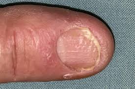 nail psoriasis causes pictures and