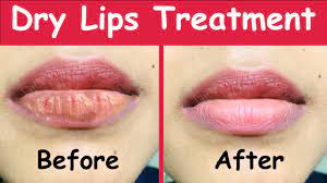 best natural dry lips treatment dry
