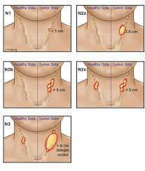 Stages Of Tonsil Cancer Headandneckcancerguide Org
