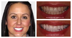 Teeth Whitening in Loughborough & Leicester