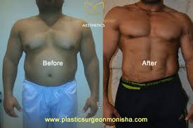 liposuction six pack abs surgery in