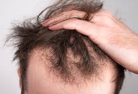 hair loss in brantford ontario