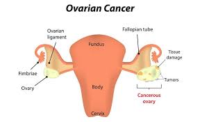 Ovarian cancer warning signs include ongoing pain or cramps in the belly or back, abnormal vaginal depending on the cancer stage, ovarian cancer treatment includes surgery and chemotherapy. Fighting Ovarian Cancer Symptoms Diagnosis Treatments