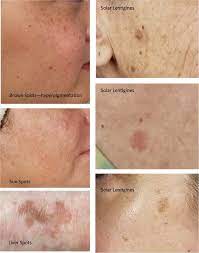 how to remove brown spots