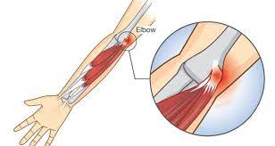 golfer s elbow symptoms causes