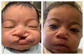 cleft lip cleft palate corrective