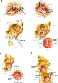 implants for orbital floor repair