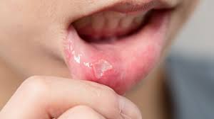 lesions ulcers and sores and how