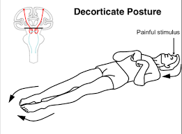 decorticate posturing flashcards quizlet