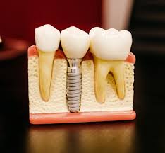 pros and cons of dental implants face