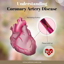 understanding coronary artery disease