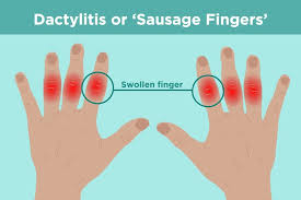 Arthritis is the swelling and tenderness of one or more of your joints. What Is Dactylitis Understanding Causes Symptoms And Treatments