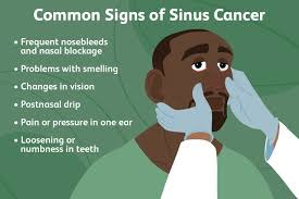sinus cancer signs symptoms and