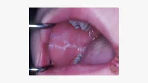 linea alba in mouth causes treatments