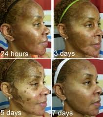 Inflammation on the skin such as injuries, allergic reactions, acne, surgery, chemical peels, can cause an inflammatory reaction in the body, which in turn, leads to overproduction of melanin and development of black patches on the skin. Chemical Peels And African American Skin