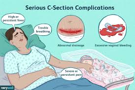 cesarean section