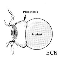 enucleation about ocular prosthesis