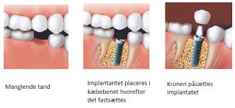 Billedresultat for tandkrone