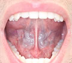 tongue tie myofunctional therapy