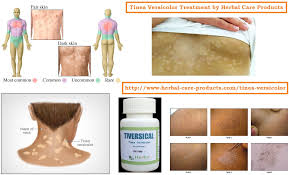 for tinea versicolor herbal care