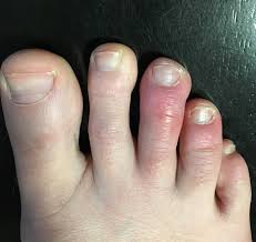 swollen ring toe causes and treatment
