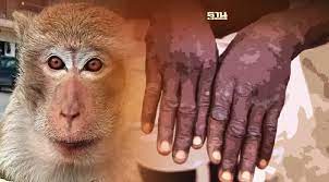 โรคฝีดาษลิง monkeypox กรมควบคุมโรคแนะวิธีป้องกัน หลังระบาดแล้ว 11 ประเทศ
