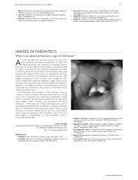 abnormal frenulum a sign of child abuse