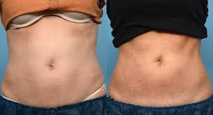 body contouring with coolsculpting