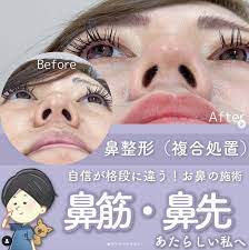 名古屋の小鼻ボトックスが安いおすすめのクリニック9選|小鼻ボトックスは効果ない？ | BinanBijo｜美容医療メディア