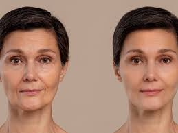 facelift healing recovery time tips