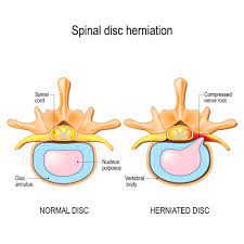 how to heal a herniated disc quickly
