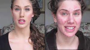 acne makeup tutorials
