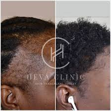 do relaxers cause hair loss reasons