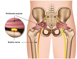 what does piriformis syndrome feel like