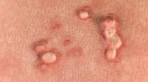 what is herpes symptoms